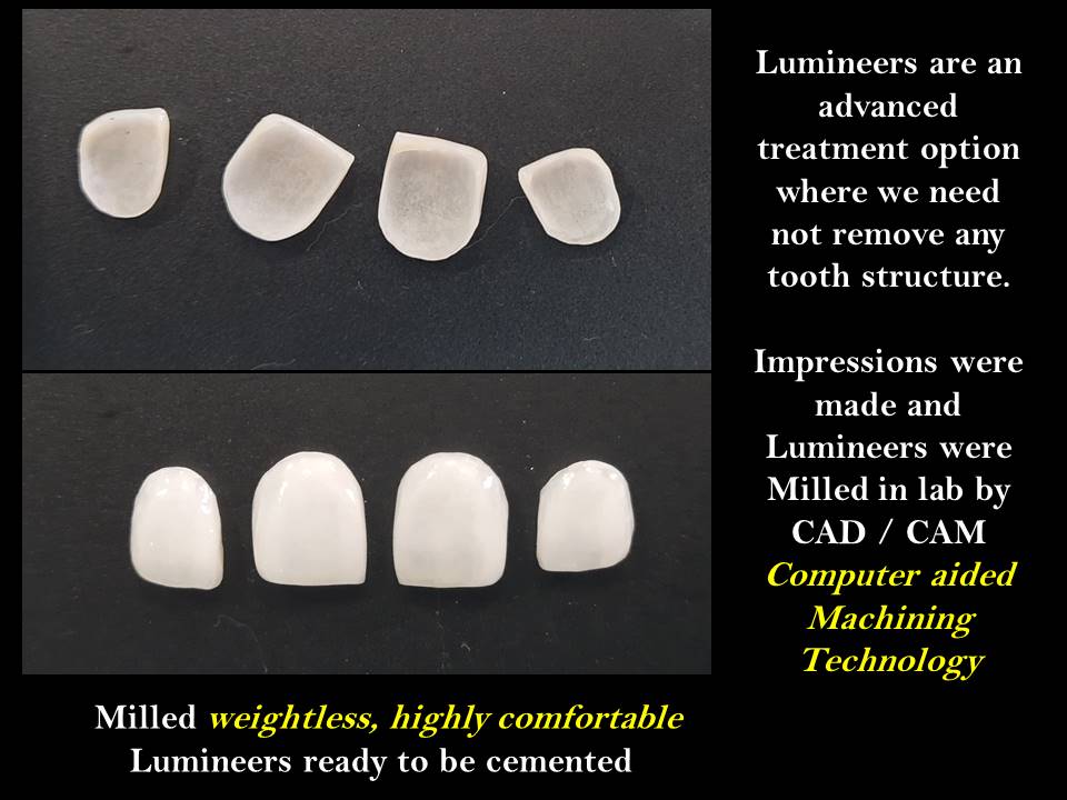 Dental lumineers for smile designing without tooth preparation in coimbatore